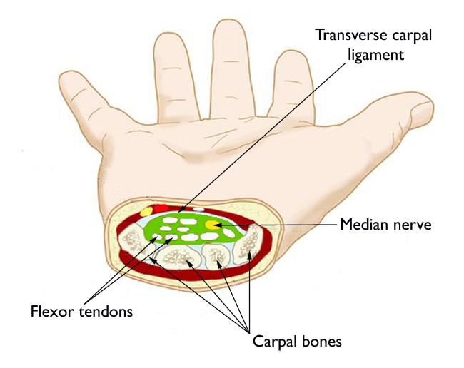 Carpal Tunnel From Guitar Playing